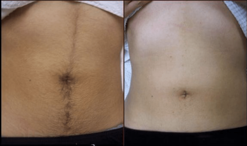epilation-before-after_-1-thousand-results-found-in-Yandex-Images-1-1.png