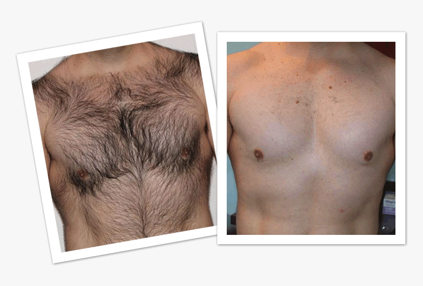 482-4829905_mens-laser-hair-removal-before-and-after-hd-1.png